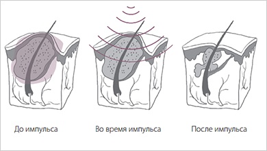 Лазерное лечение акне Лазерное лечение акне