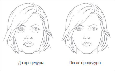 RF-лифтинг RF-лифтинг