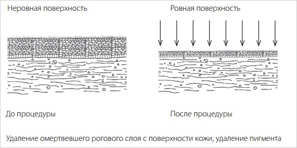 Срединные пилинги Срединные пилинги