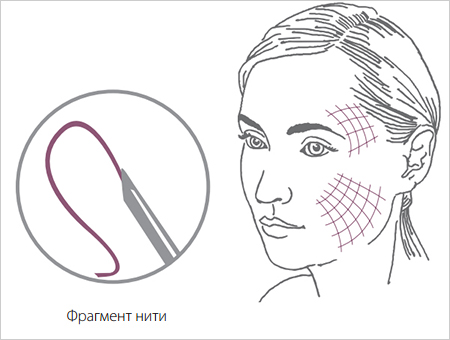 мезонити мезонити