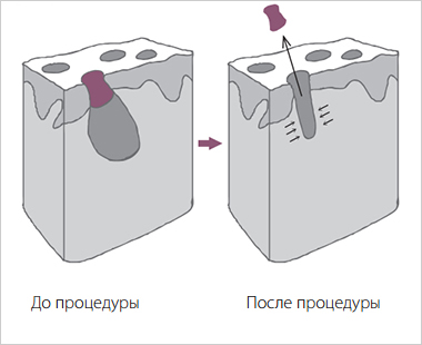 чистка лица чистка лица