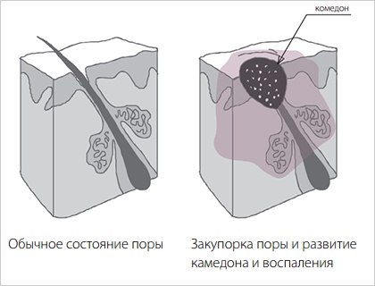 лечение угревой сыпи лечение угревой сыпи