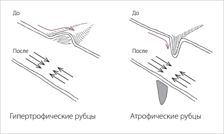 Коррекция рубцов Коррекция рубцов