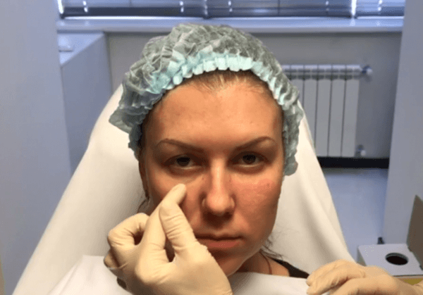 Коррекция носослезной борозды